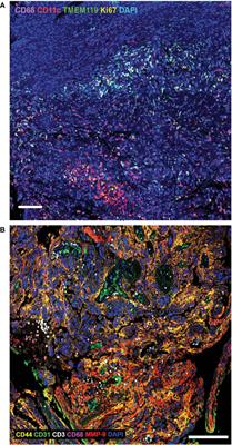 Advances in CAR T cell immunotherapy for paediatric brain tumours